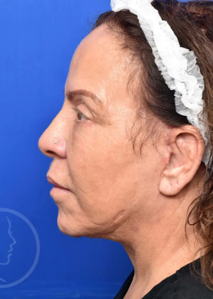 Plastic Surgery Before and After Pictures in Jacksonville, FL - Garcia Facial Plastic Surgery