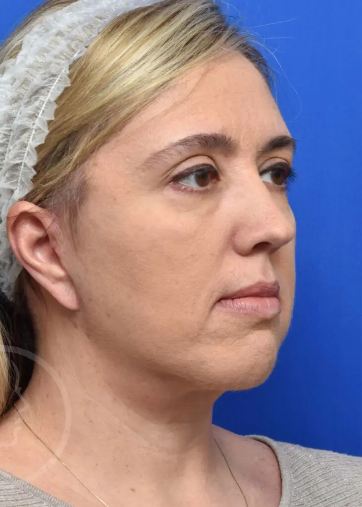 Plastic Surgery Before and After Pictures in Jacksonville, FL - Garcia Facial Plastic Surgery