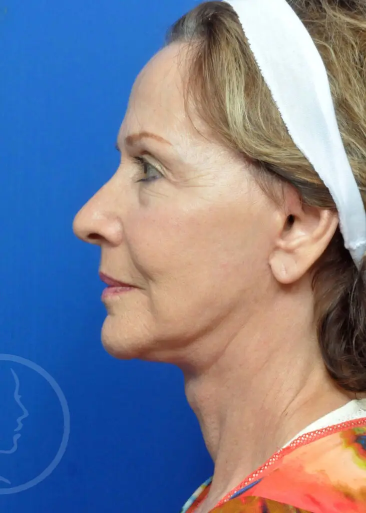 Plastic Surgery Before and After Pictures in Jacksonville, FL - Garcia Facial Plastic Surgery