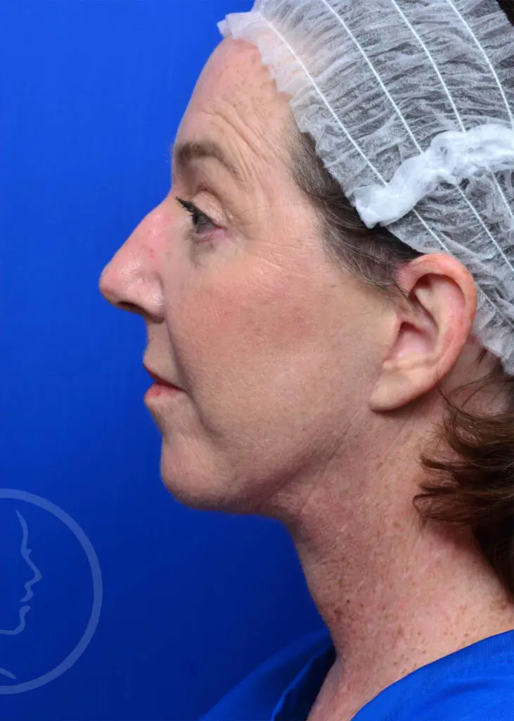 Plastic Surgery Before and After Pictures in Jacksonville, FL - Garcia Facial Plastic Surgery