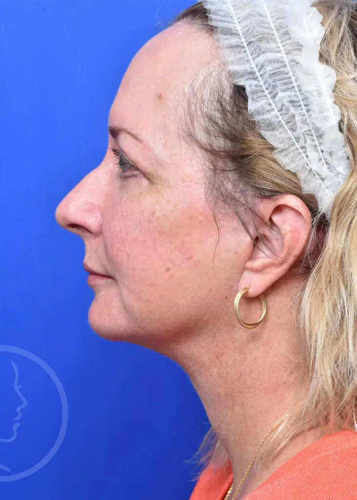 Plastic Surgery Before and After Pictures in Jacksonville, FL - Garcia Facial Plastic Surgery