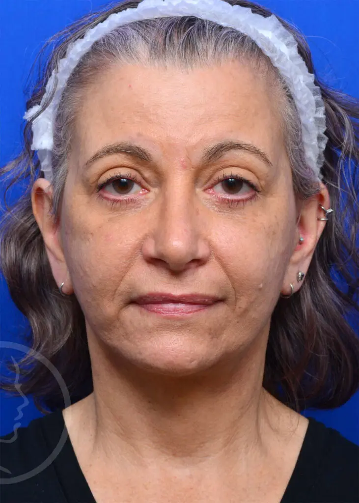 Plastic Surgery Before and After Pictures in Jacksonville, FL - Garcia Facial Plastic Surgery