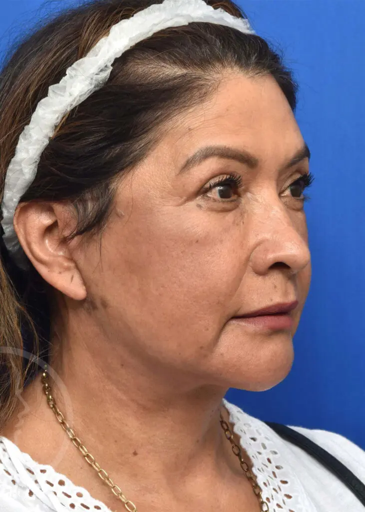 Plastic Surgery Before and After Pictures in Jacksonville, FL - Garcia Facial Plastic Surgery