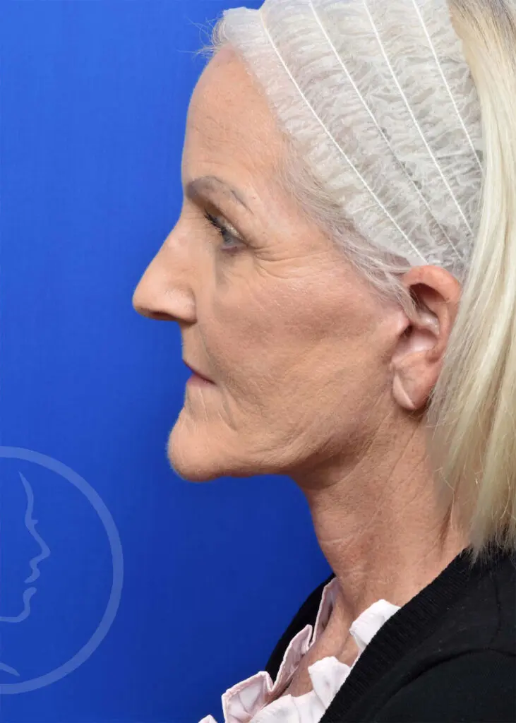 Plastic Surgery Before and After Pictures in Jacksonville, FL - Garcia Facial Plastic Surgery