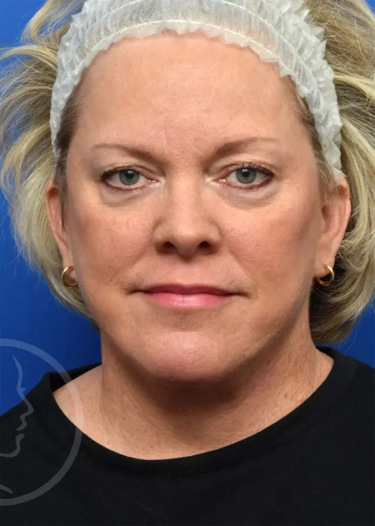 Plastic Surgery Before and After Pictures in Jacksonville, FL - Garcia Facial Plastic Surgery