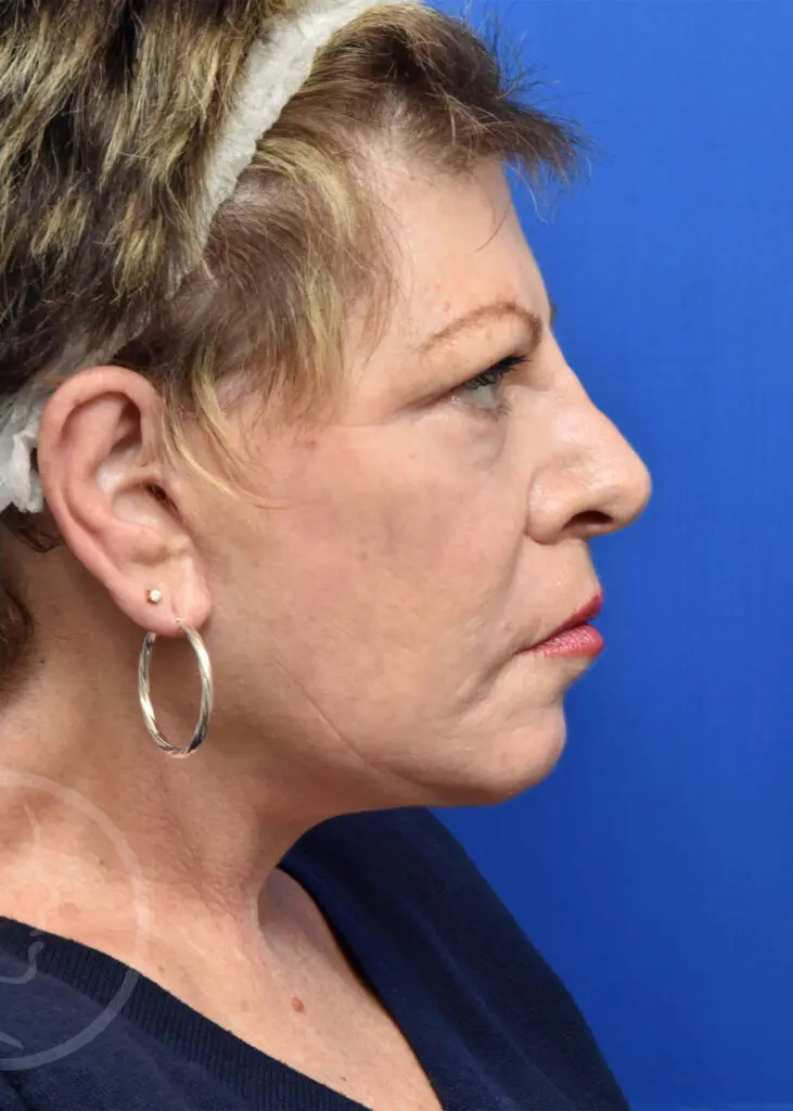 Plastic Surgery Before and After Pictures in Jacksonville, FL - Garcia Facial Plastic Surgery