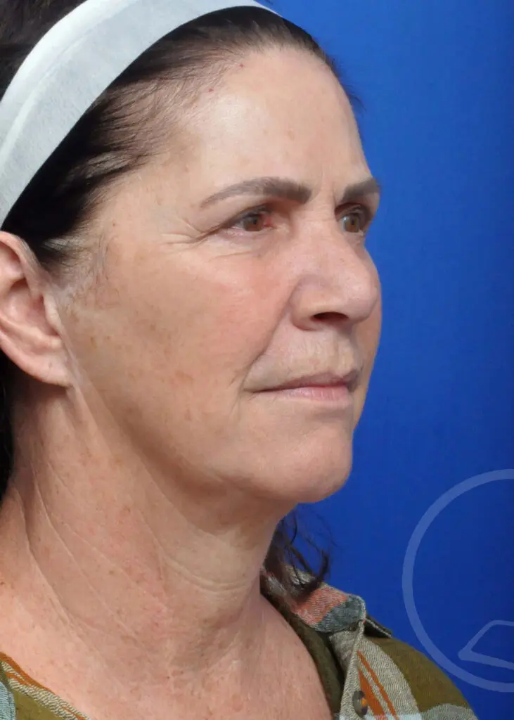Plastic Surgery Before and After Pictures in Jacksonville, FL - Garcia Facial Plastic Surgery