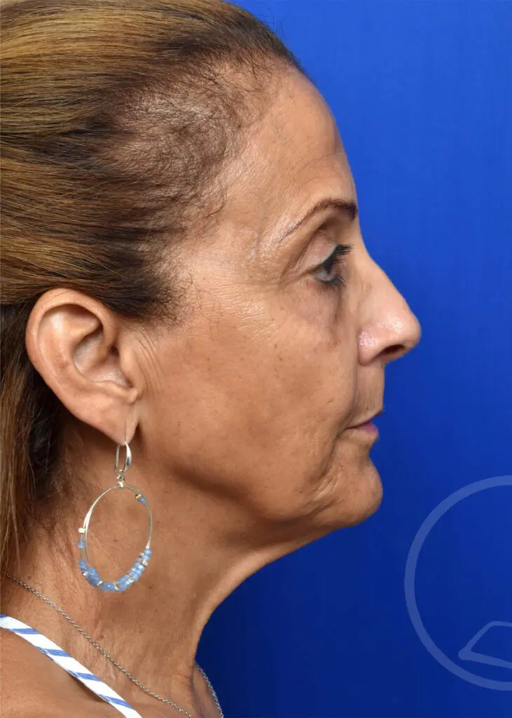 Plastic Surgery Before and After Pictures in Jacksonville, FL - Garcia Facial Plastic Surgery