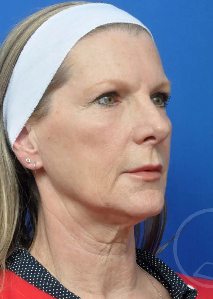 Plastic Surgery Before and After Pictures in Jacksonville, FL - Garcia Facial Plastic Surgery