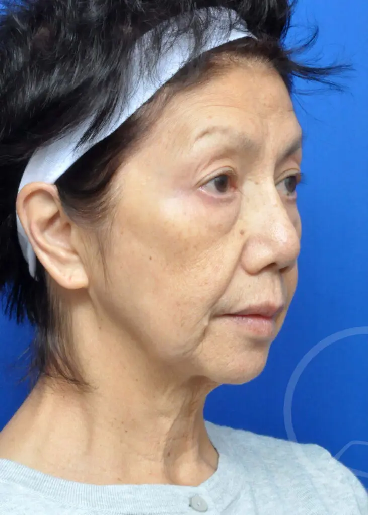 Plastic Surgery Before and After Pictures in Jacksonville, FL - Garcia Facial Plastic Surgery