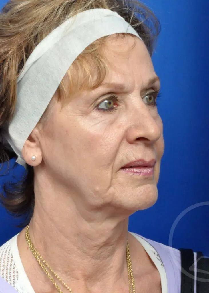 Plastic Surgery Before and After Pictures in Jacksonville, FL - Garcia Facial Plastic Surgery