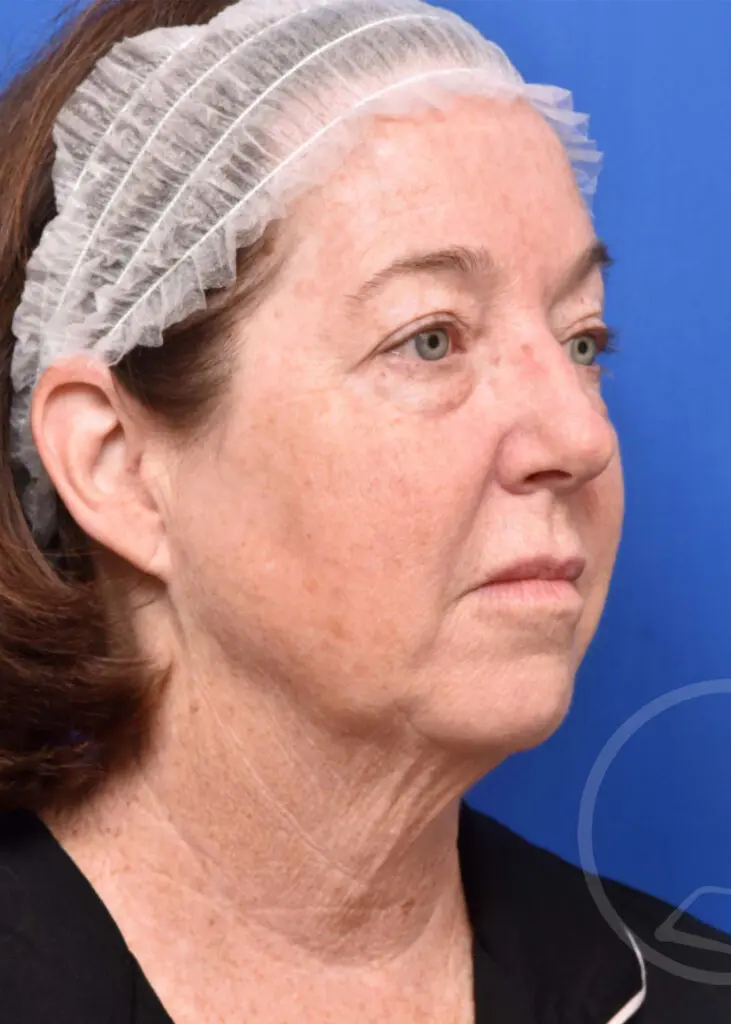 Plastic Surgery Before and After Pictures in Jacksonville, FL - Garcia Facial Plastic Surgery