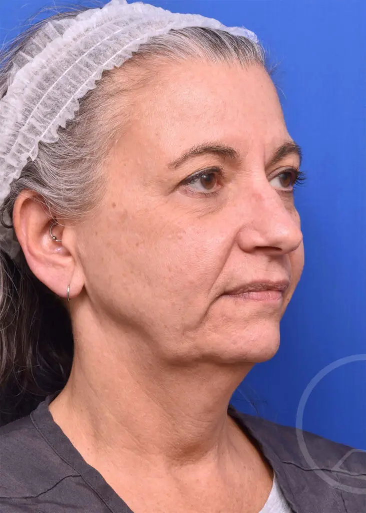 Plastic Surgery Before and After Pictures in Jacksonville, FL - Garcia Facial Plastic Surgery
