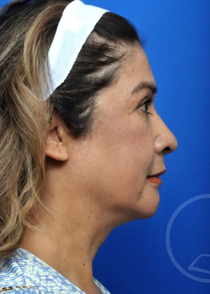 Plastic Surgery Before and After Pictures in Jacksonville, FL - Garcia Facial Plastic Surgery