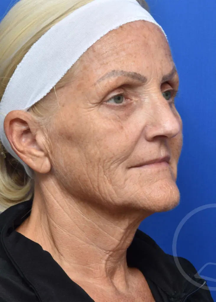 Plastic Surgery Before and After Pictures in Jacksonville, FL - Garcia Facial Plastic Surgery