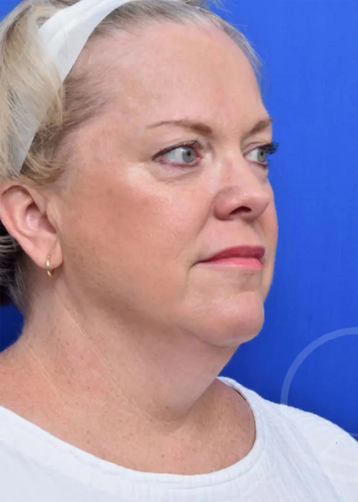 Plastic Surgery Before and After Pictures in Jacksonville, FL - Garcia Facial Plastic Surgery