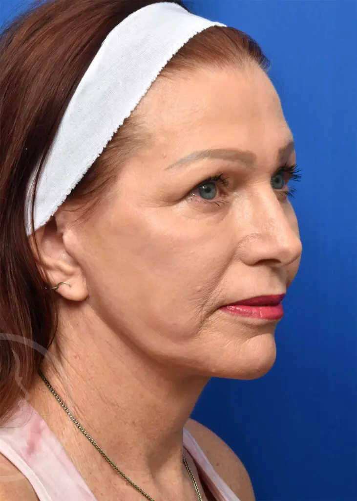 Plastic Surgery Before and After Pictures in Jacksonville, FL - Garcia Facial Plastic Surgery