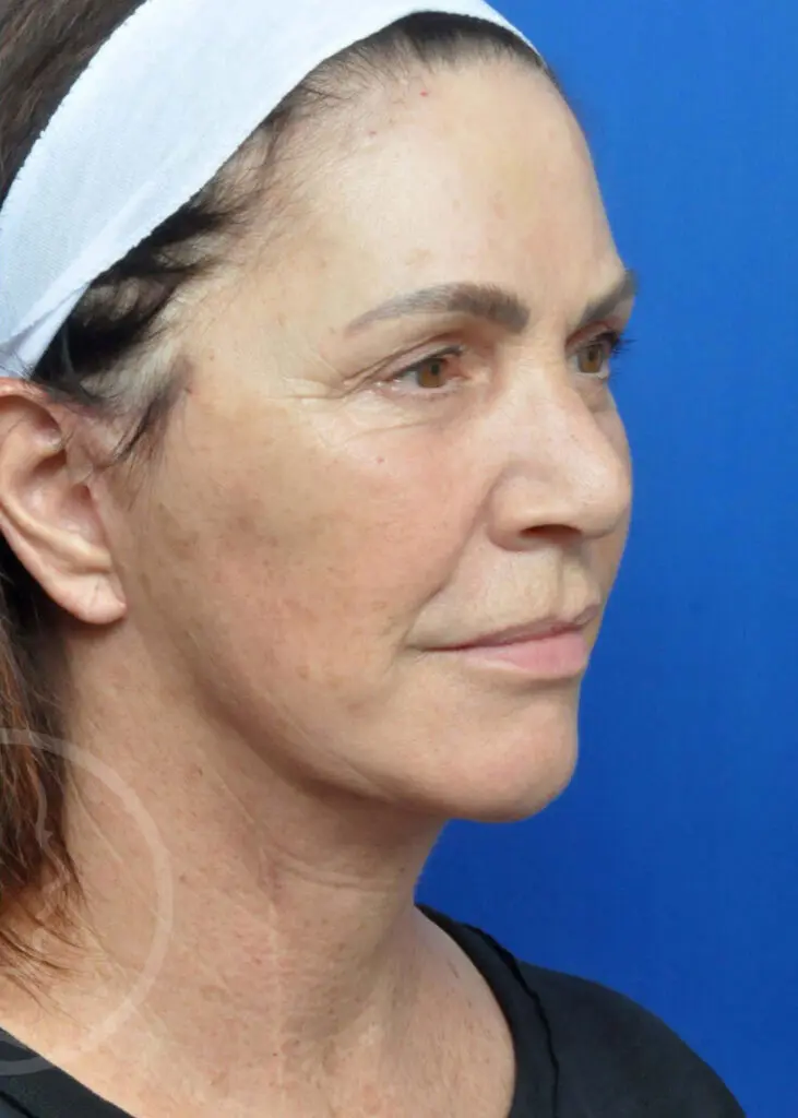 Plastic Surgery Before and After Pictures in Jacksonville, FL - Garcia Facial Plastic Surgery