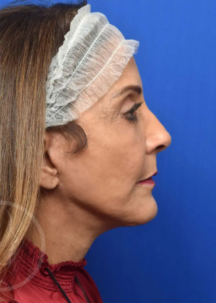 Plastic Surgery Before and After Pictures in Jacksonville, FL - Garcia Facial Plastic Surgery