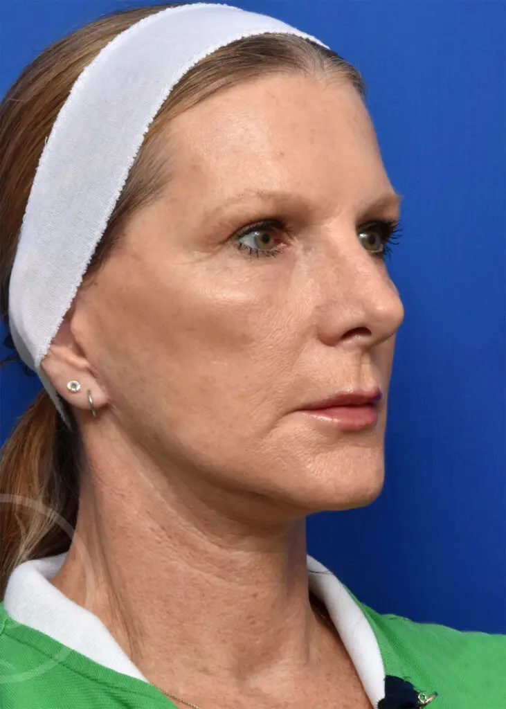Plastic Surgery Before and After Pictures in Jacksonville, FL - Garcia Facial Plastic Surgery