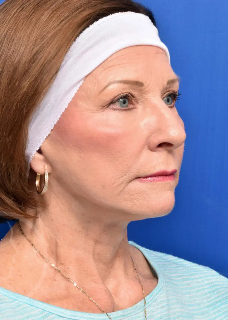Plastic Surgery Before and After Pictures in Jacksonville, FL - Garcia Facial Plastic Surgery
