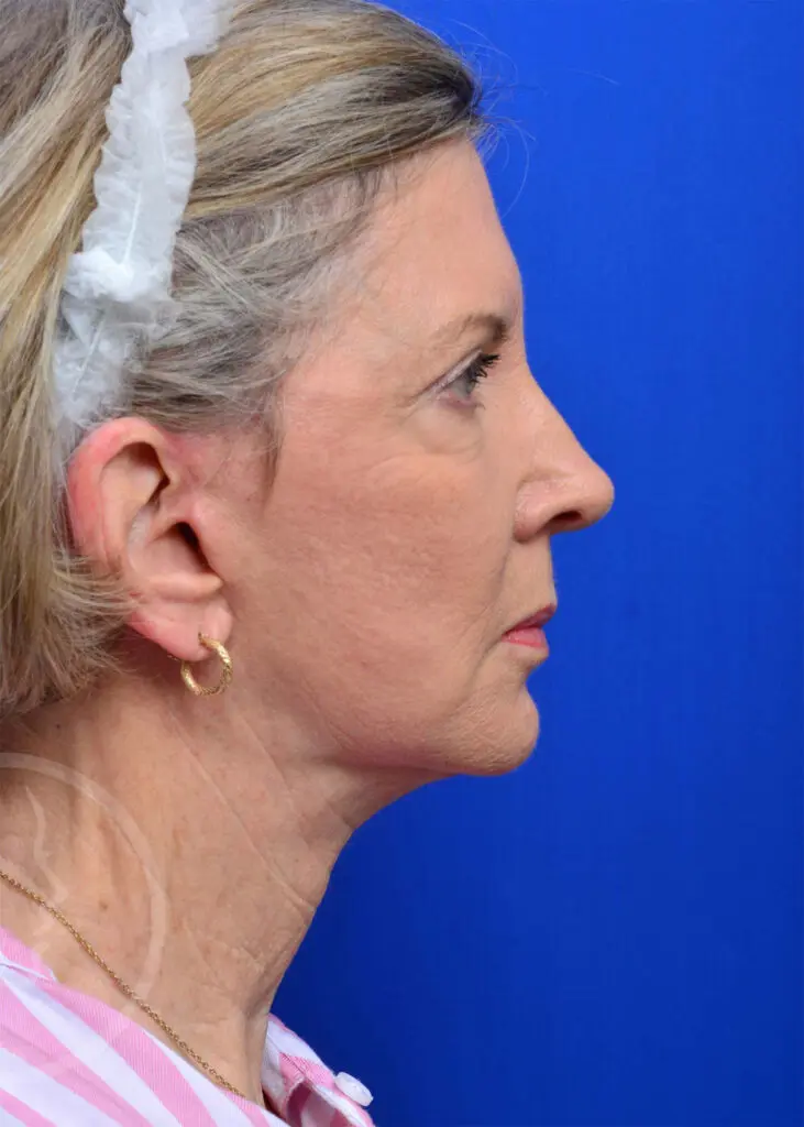 Plastic Surgery Before and After Pictures in Jacksonville, FL - Garcia Facial Plastic Surgery