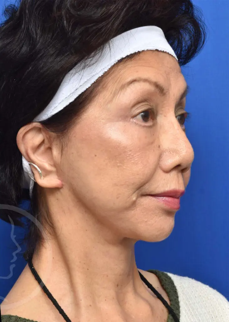 Plastic Surgery Before and After Pictures in Jacksonville, FL - Garcia Facial Plastic Surgery