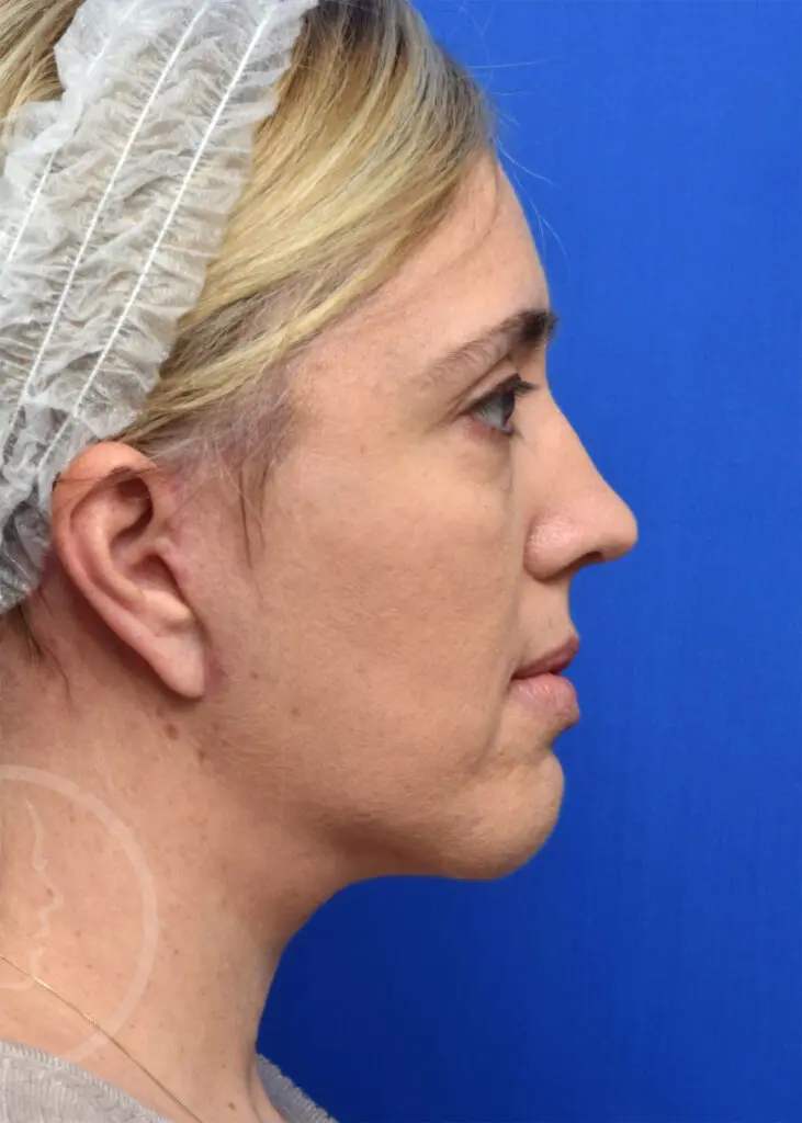 Plastic Surgery Before and After Pictures in Jacksonville, FL - Garcia Facial Plastic Surgery