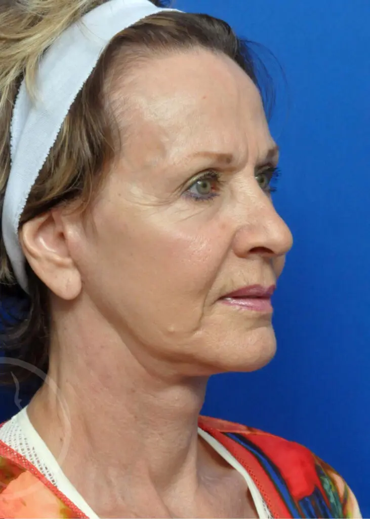 Plastic Surgery Before and After Pictures in Jacksonville, FL - Garcia Facial Plastic Surgery