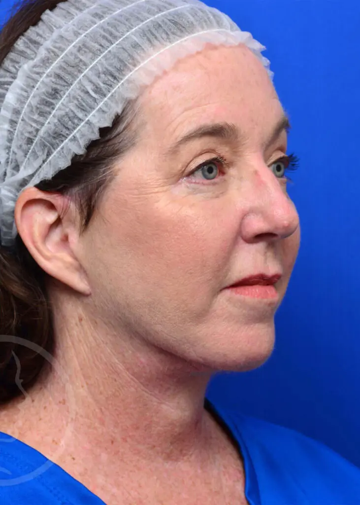 Plastic Surgery Before and After Pictures in Jacksonville, FL - Garcia Facial Plastic Surgery