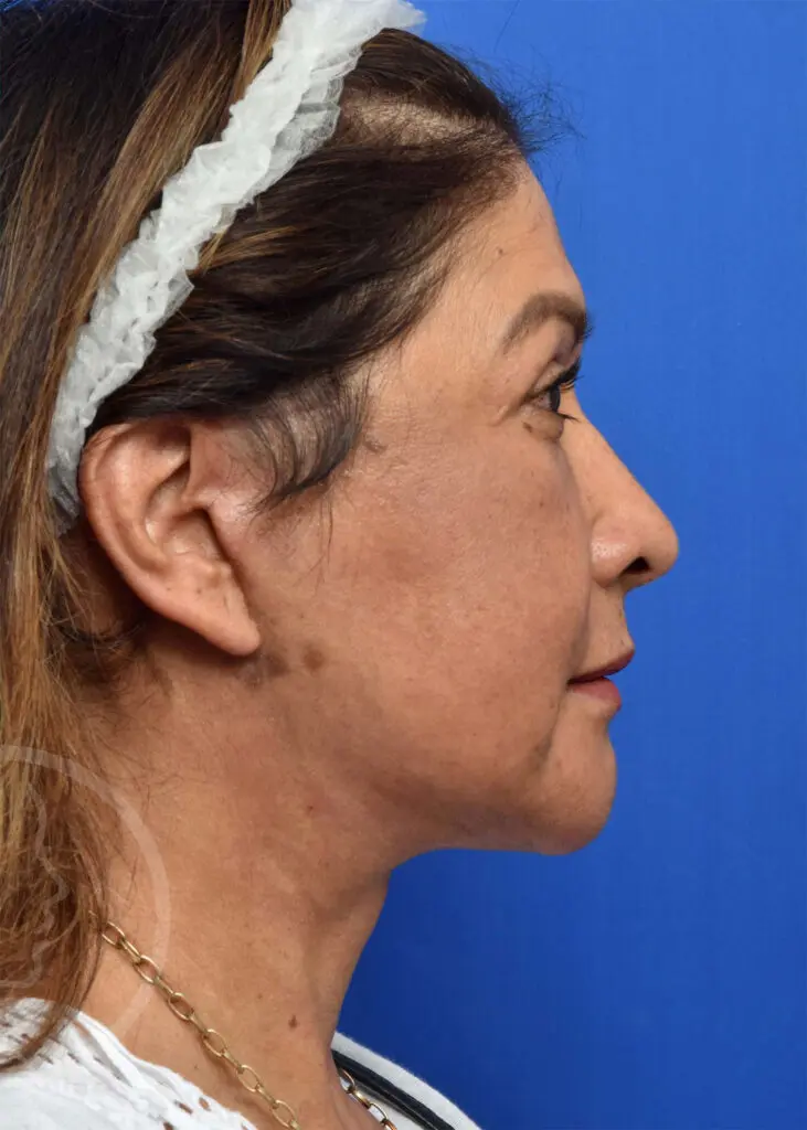 Plastic Surgery Before and After Pictures in Jacksonville, FL - Garcia Facial Plastic Surgery
