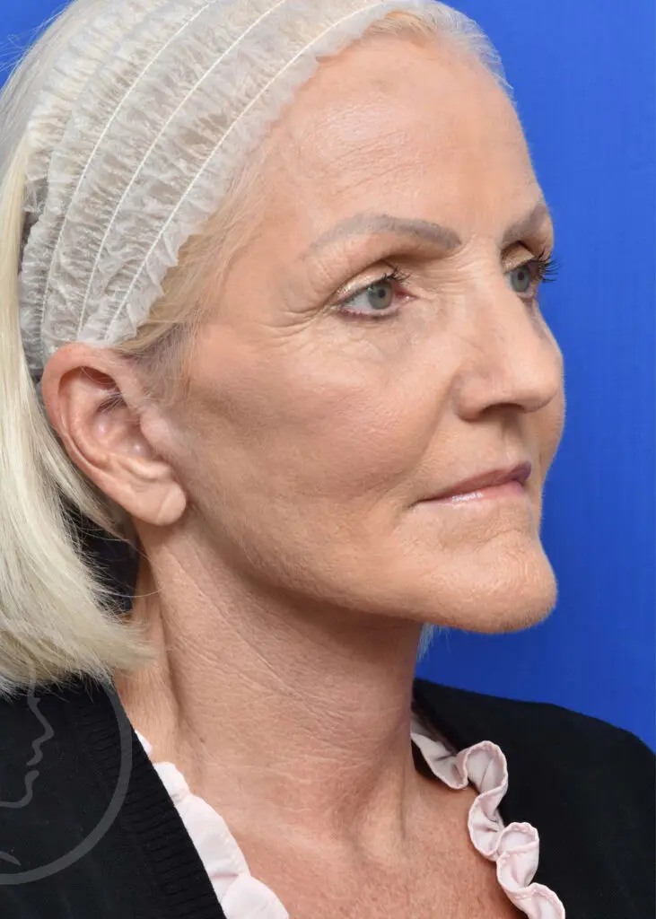 Plastic Surgery Before and After Pictures in Jacksonville, FL - Garcia Facial Plastic Surgery