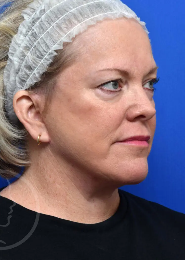 Plastic Surgery Before and After Pictures in Jacksonville, FL - Garcia Facial Plastic Surgery