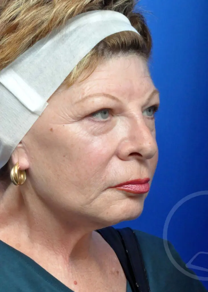Plastic Surgery Before and After Pictures in Jacksonville, FL - Garcia Facial Plastic Surgery