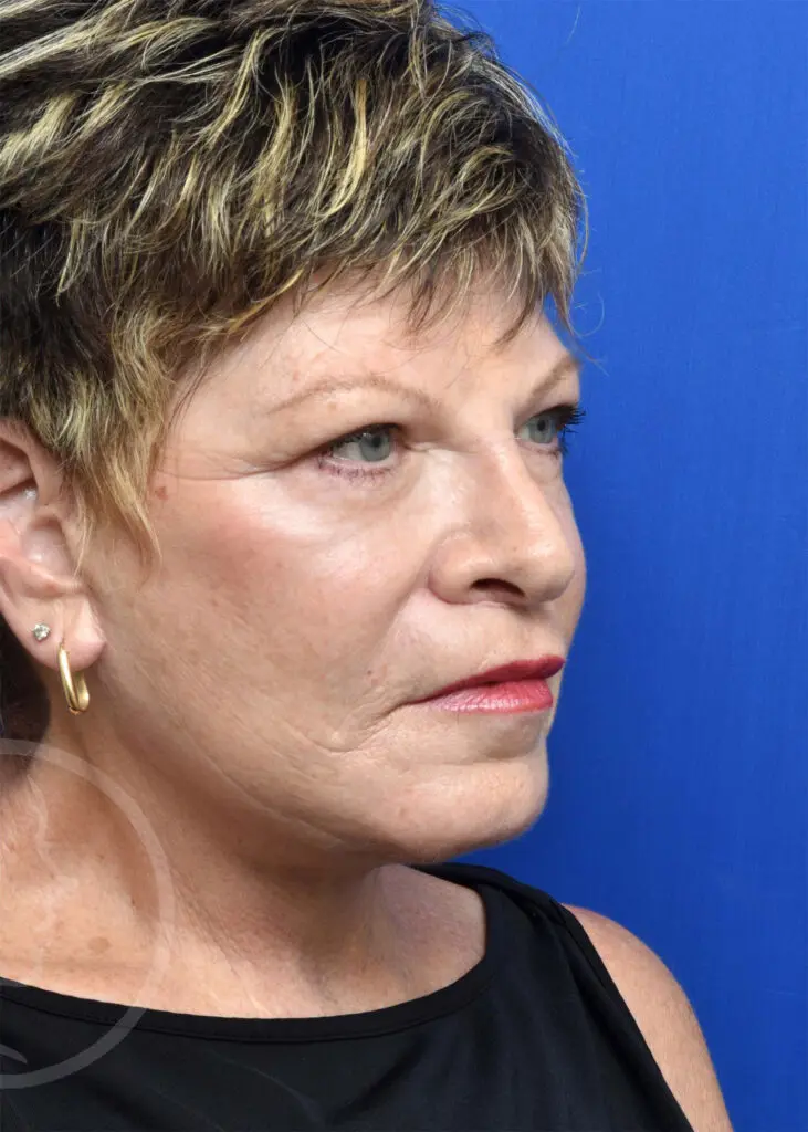 Plastic Surgery Before and After Pictures in Jacksonville, FL - Garcia Facial Plastic Surgery