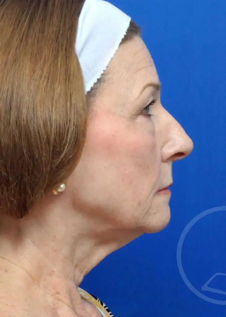 Plastic Surgery Before and After Pictures in Jacksonville, FL - Garcia Facial Plastic Surgery