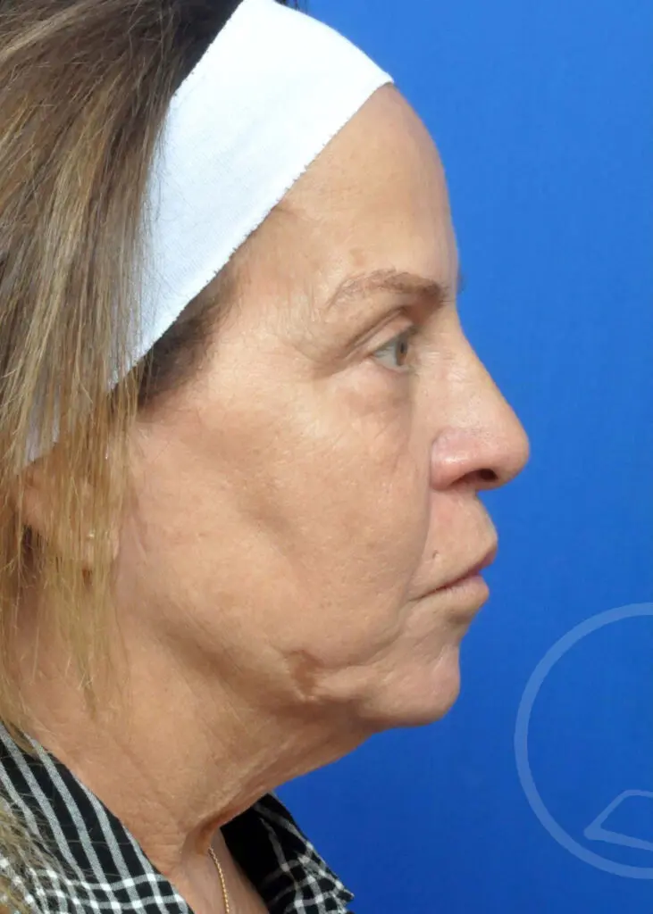 Plastic Surgery Before and After Pictures in Jacksonville, FL - Garcia Facial Plastic Surgery