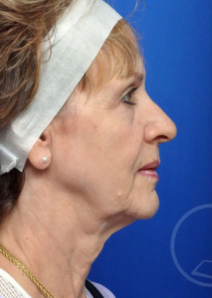 Plastic Surgery Before and After Pictures in Jacksonville, FL - Garcia Facial Plastic Surgery