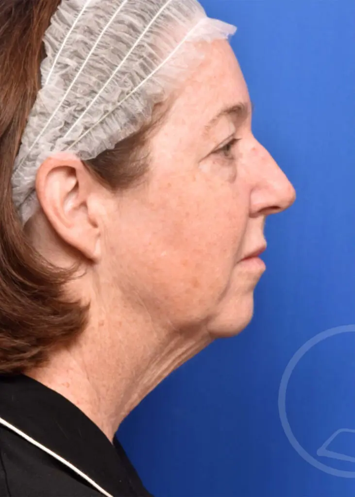 Plastic Surgery Before and After Pictures in Jacksonville, FL - Garcia Facial Plastic Surgery