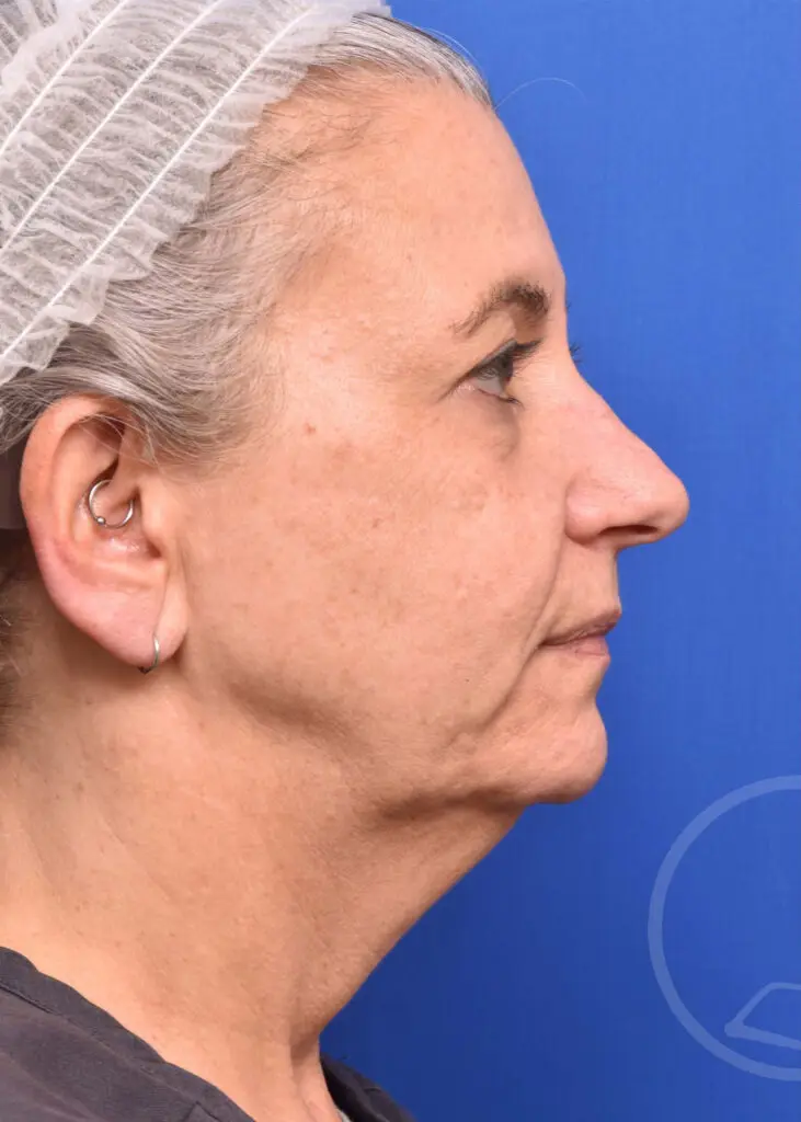 Plastic Surgery Before and After Pictures in Jacksonville, FL - Garcia Facial Plastic Surgery