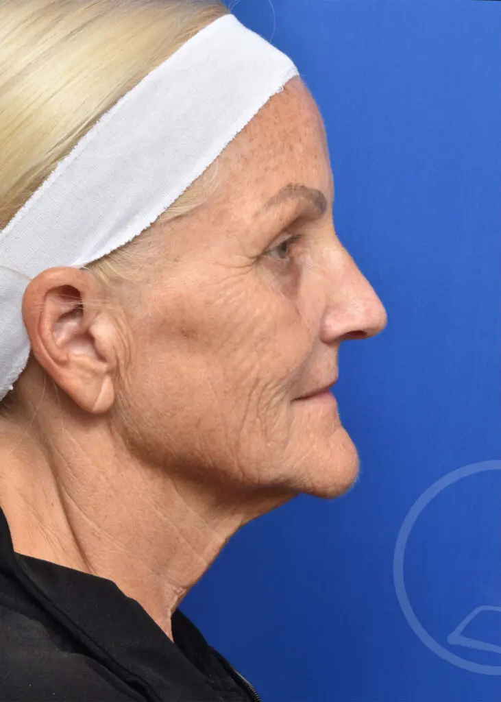 Plastic Surgery Before and After Pictures in Jacksonville, FL - Garcia Facial Plastic Surgery