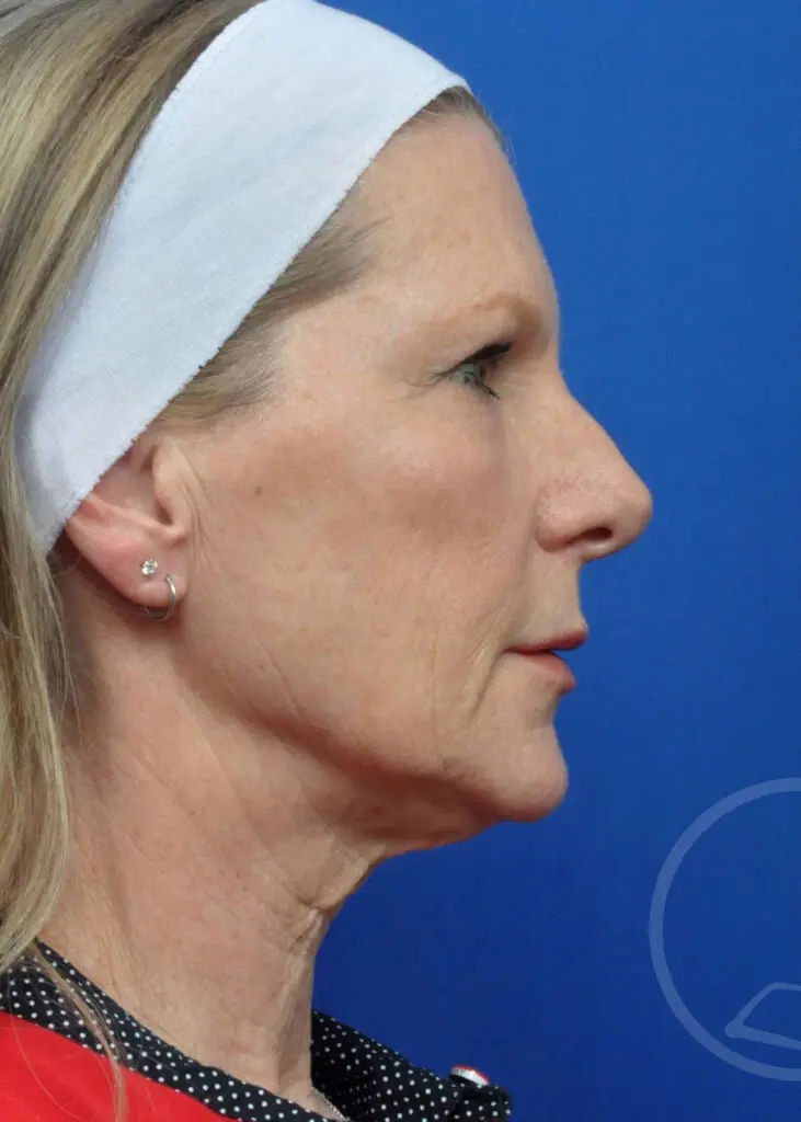 Plastic Surgery Before and After Pictures in Jacksonville, FL - Garcia Facial Plastic Surgery