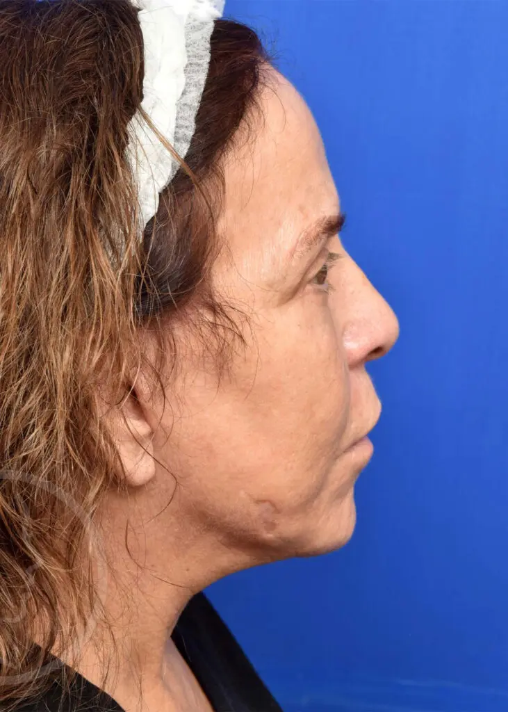 Plastic Surgery Before and After Pictures in Jacksonville, FL - Garcia Facial Plastic Surgery