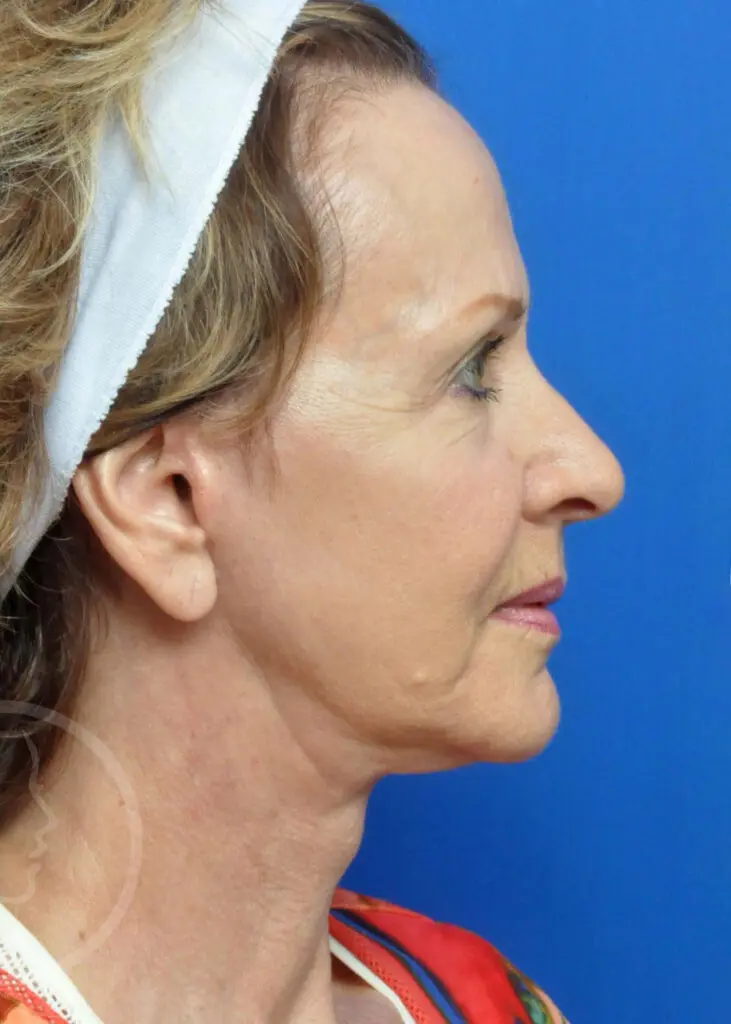 Plastic Surgery Before and After Pictures in Jacksonville, FL - Garcia Facial Plastic Surgery