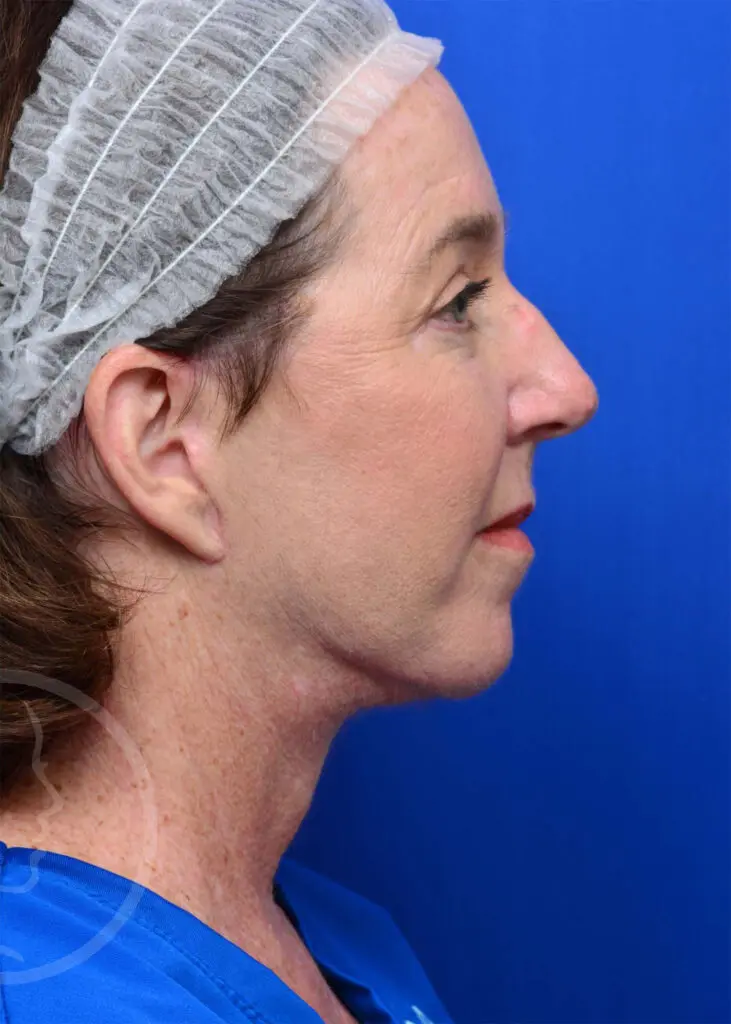 Plastic Surgery Before and After Pictures in Jacksonville, FL - Garcia Facial Plastic Surgery