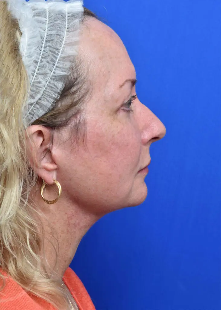 Plastic Surgery Before and After Pictures in Jacksonville, FL - Garcia Facial Plastic Surgery