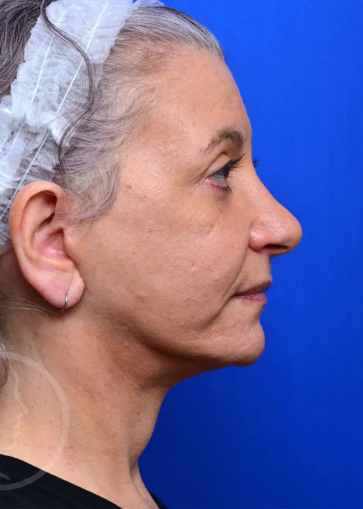 Plastic Surgery Before and After Pictures in Jacksonville, FL - Garcia Facial Plastic Surgery