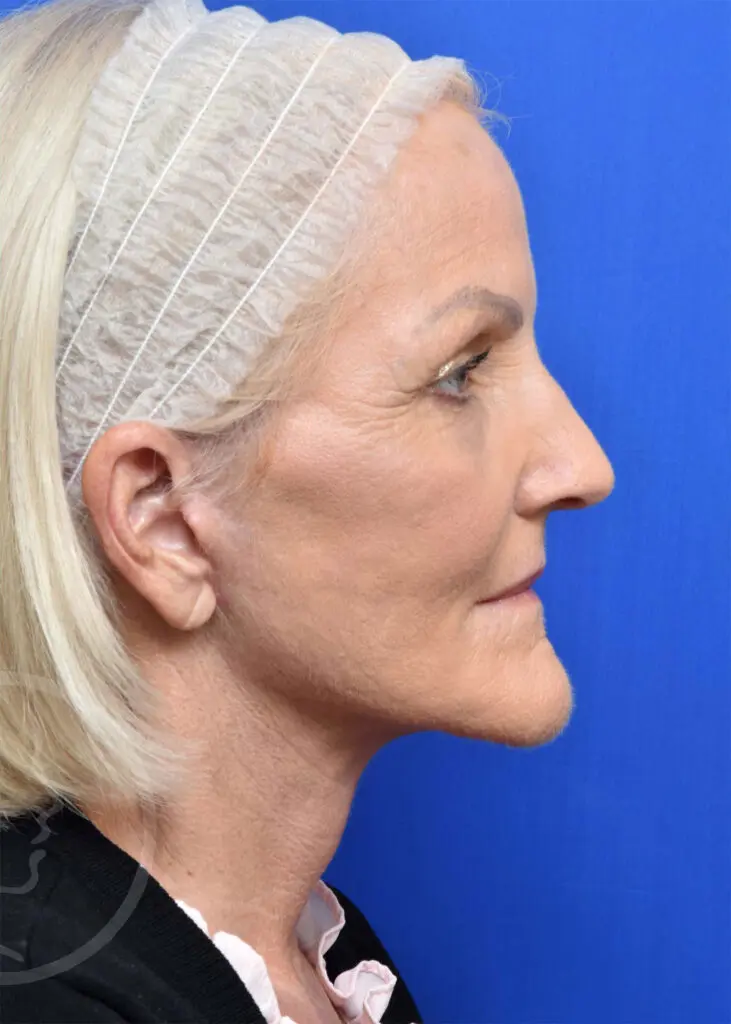 Plastic Surgery Before and After Pictures in Jacksonville, FL - Garcia Facial Plastic Surgery