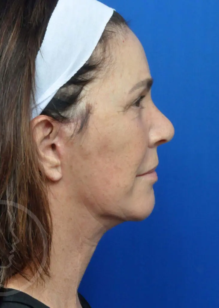 Plastic Surgery Before and After Pictures in Jacksonville, FL - Garcia Facial Plastic Surgery