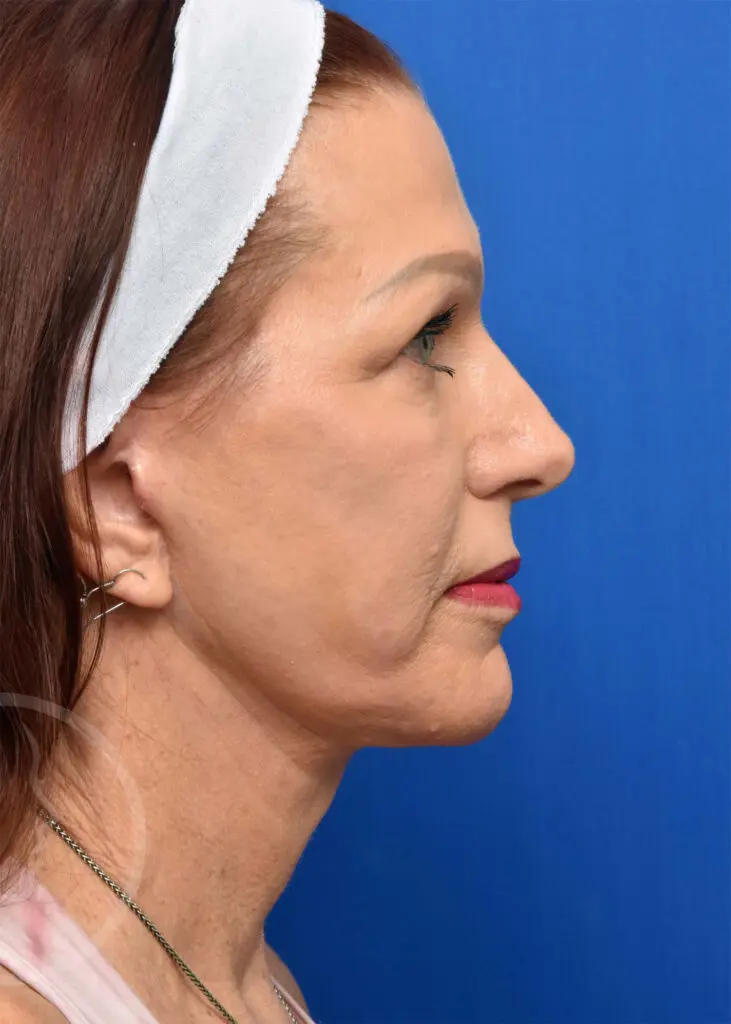 Plastic Surgery Before and After Pictures in Jacksonville, FL - Garcia Facial Plastic Surgery